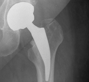 Defective Hip Implants