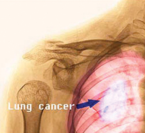 Failure to Diagnose Cancer